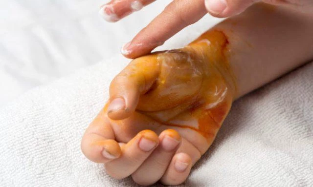 Έγκαυμα: Το πρώτο βήμα που πρέπει να κάνετε αν καείτε!